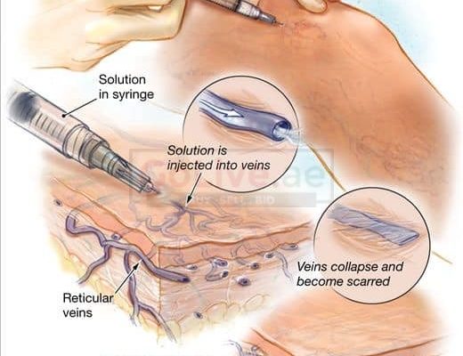 Varicose Veins Treatments