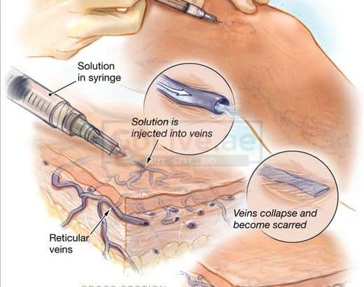 Varicose Veins Treatments
