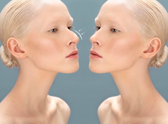 Best rhinoplasty surgeon in Dubai