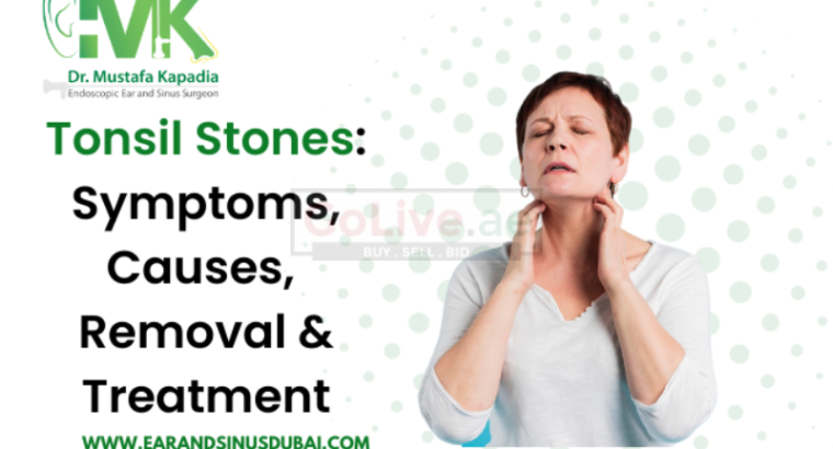 Popping Hidden Tonsil Stones – What Causes Tonsil Stones?