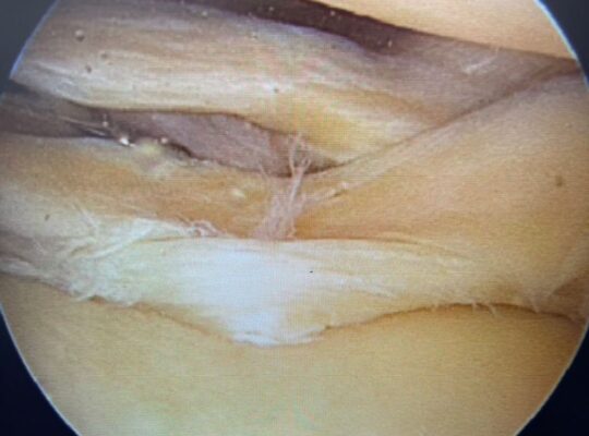 Meniscal Surgery In Dubai | Best Knee Doctor In Dubai- Dr Rik Kundra
