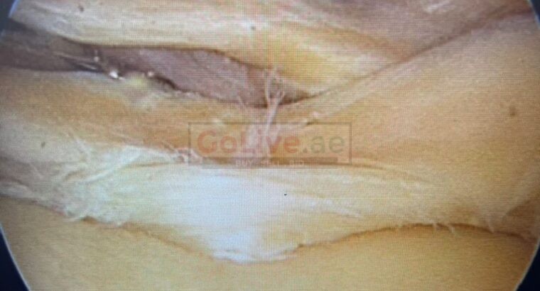 Meniscal Surgery In Dubai | Best Knee Doctor In Dubai- Dr Rik Kundra