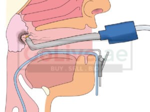 adenoid surgery in Dubai | Dr Mustafa Kapadia