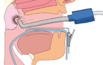 adenoid surgery in Dubai | Dr Mustafa Kapadia