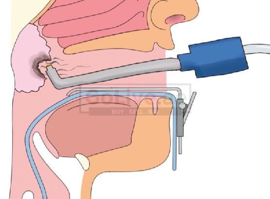 adenoid surgery in Dubai | Dr Mustafa Kapadia